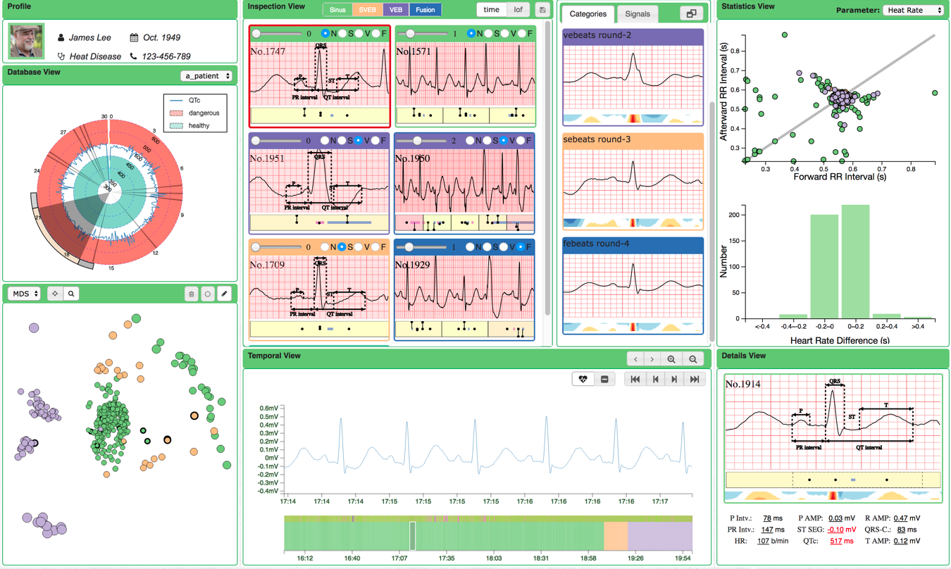 ECGLens: Interactive Visual Exploration of Large Scale ECG Data for Arrhythmia Detection